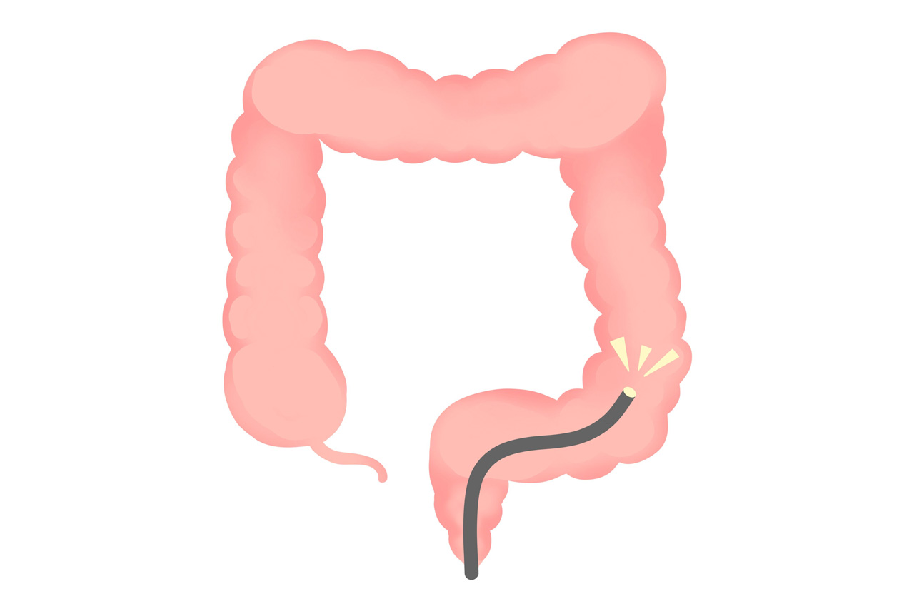 札幌駅で大腸カメラを受けるなら ～快適な検査を提供するさっぽろ駅前内科・内視鏡クリニックへ～
